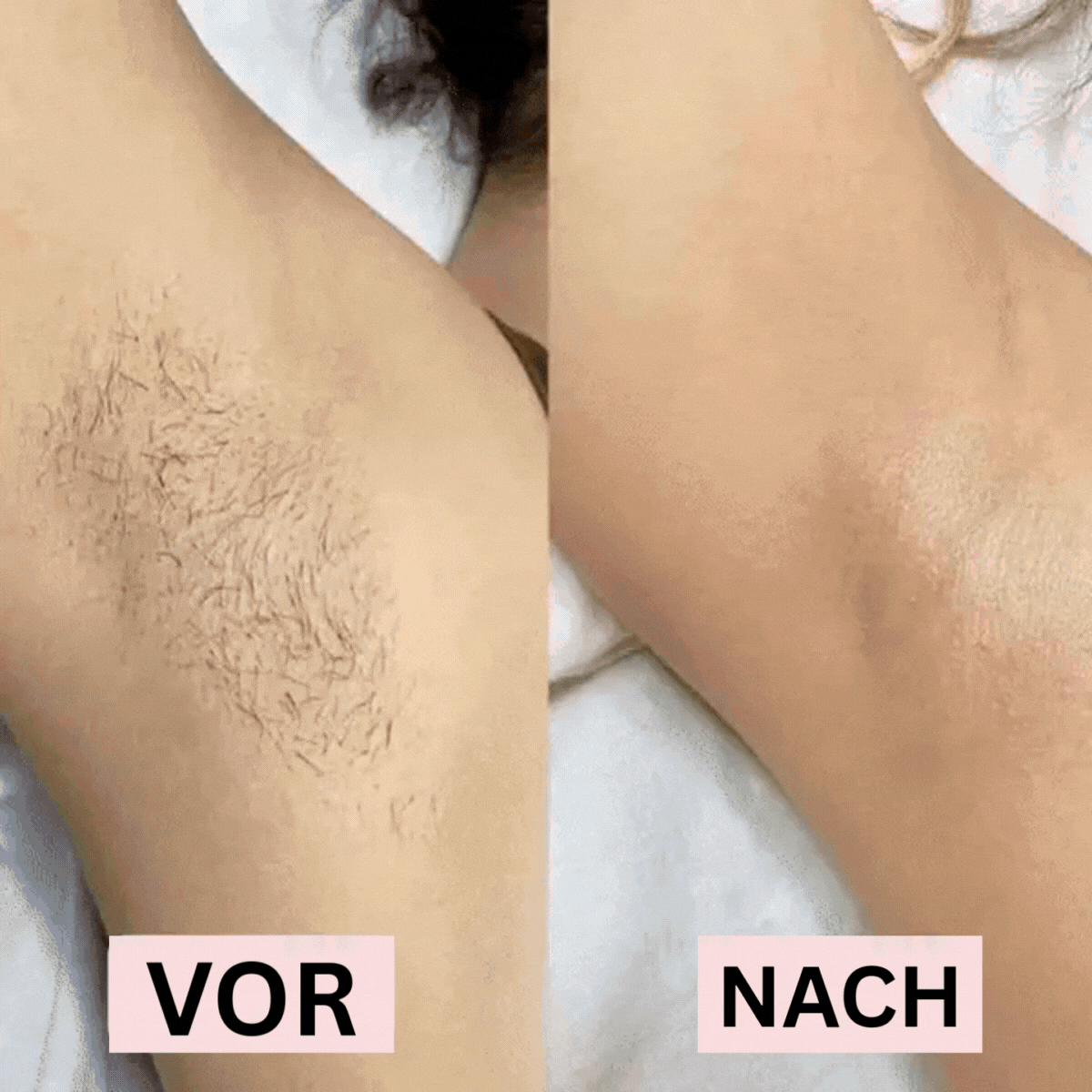 BabyBlüten™ / Nie wieder Schmerzen, glatte Haut, keine Peinlichkeiten mehr
