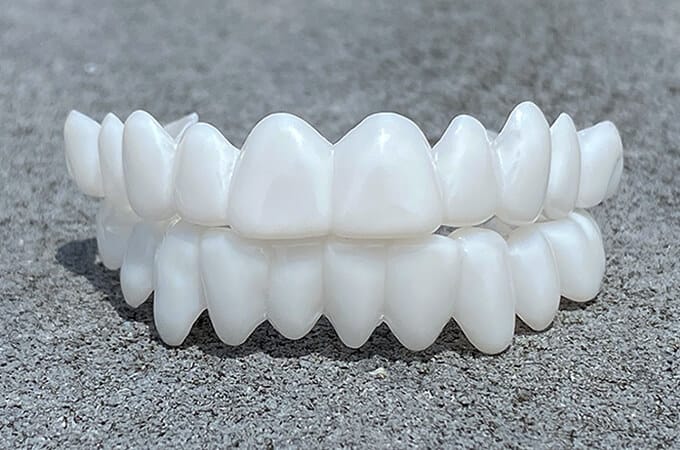 Licówki Dentystyczne DentAlign – Naturalne Dopasowanie i Wygoda 1