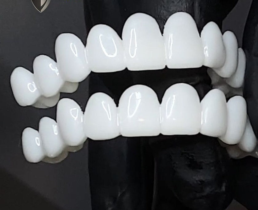 Licówki Dentystyczne DentAlign – Naturalne Dopasowanie i Wygoda 4
